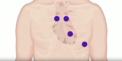 Illustration des zones d'auscultation thoraciques, représentées par des points bleus.
